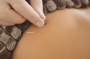 Close-up of physiotherapist inserting needle for dry needling on patient